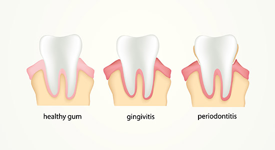 What are the symptoms of periodontal gum disease?